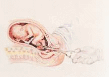 Animation of a partial birth abortion.